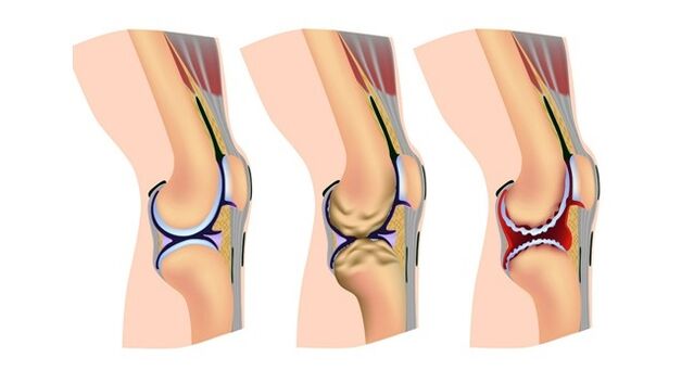 stadia artrozy stawu kolanowego