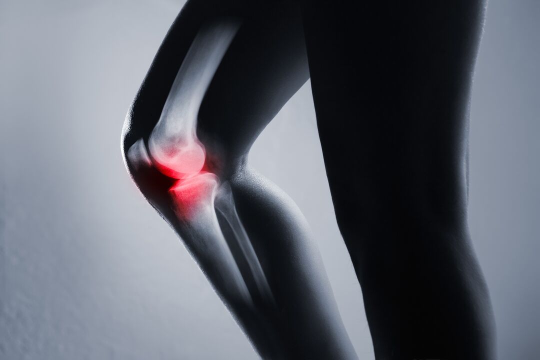 zapalenie stawu kolanowego z artrozą