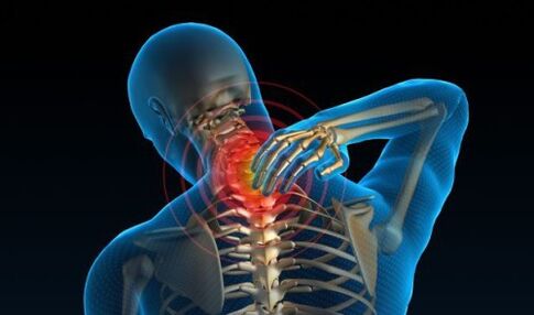 ból kręgosłupa szyjnego z osteochondrozą