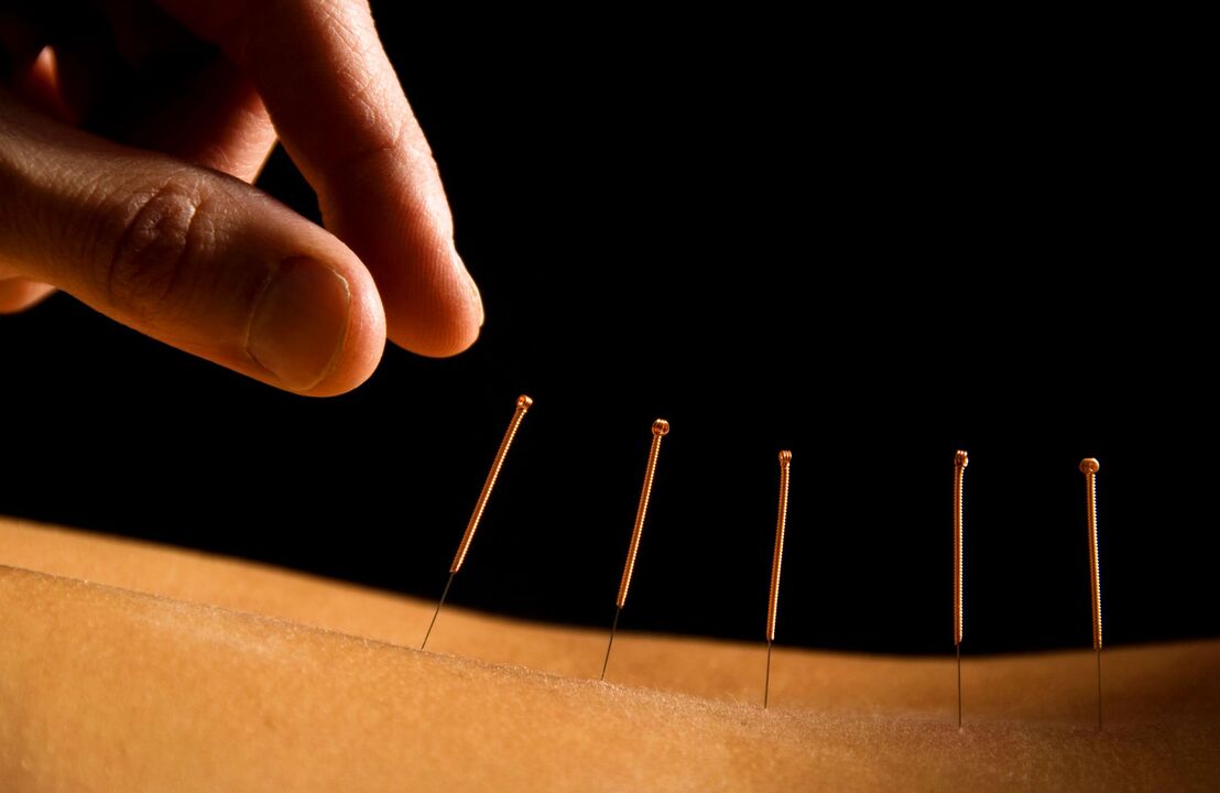 akupunktura na ból pleców