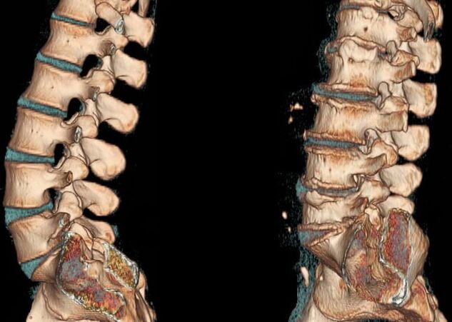 Osteochondroza obszaru lędźwiowego