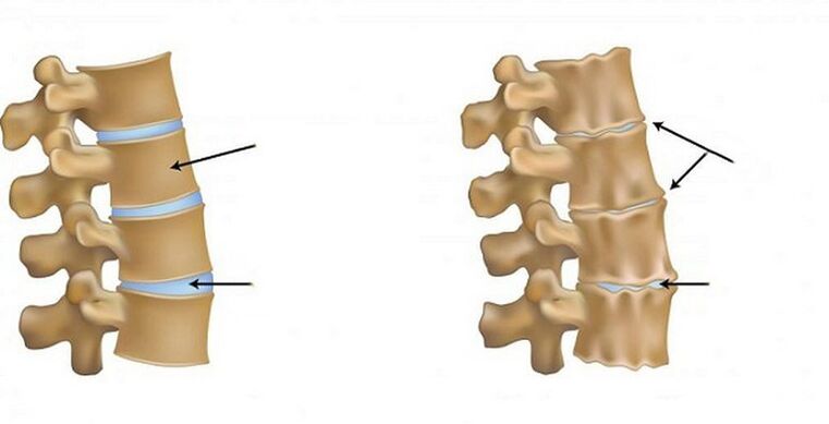 Zespół niedokrwienny dla osteochondrozy