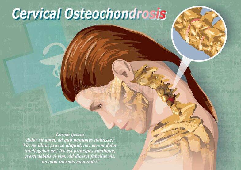 osteochondroza szyjna jest chorobą tkanki chrzęstnej