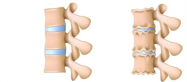 Osteochondroza od wewnątrz